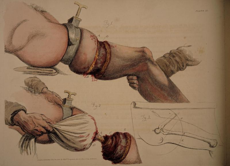 Bell, The Great Operations of Surgery Plate IX